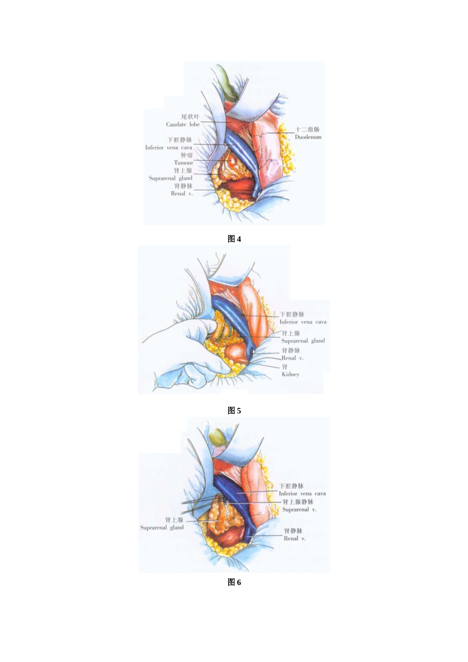 双侧肾上腺切除术_第3页