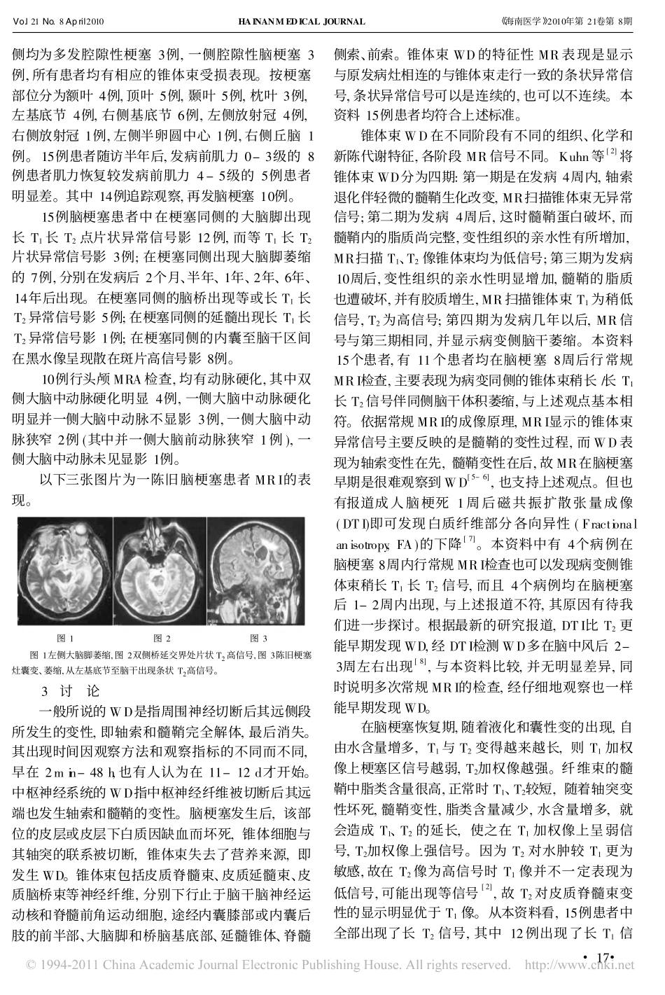 脑梗塞后锥体束Wallerian变性的MRI表现_第2页