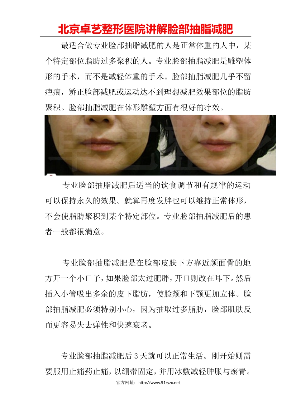 脸部抽脂减肥_第2页