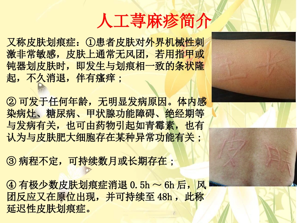 人工荨麻疹能治好吗_第2页