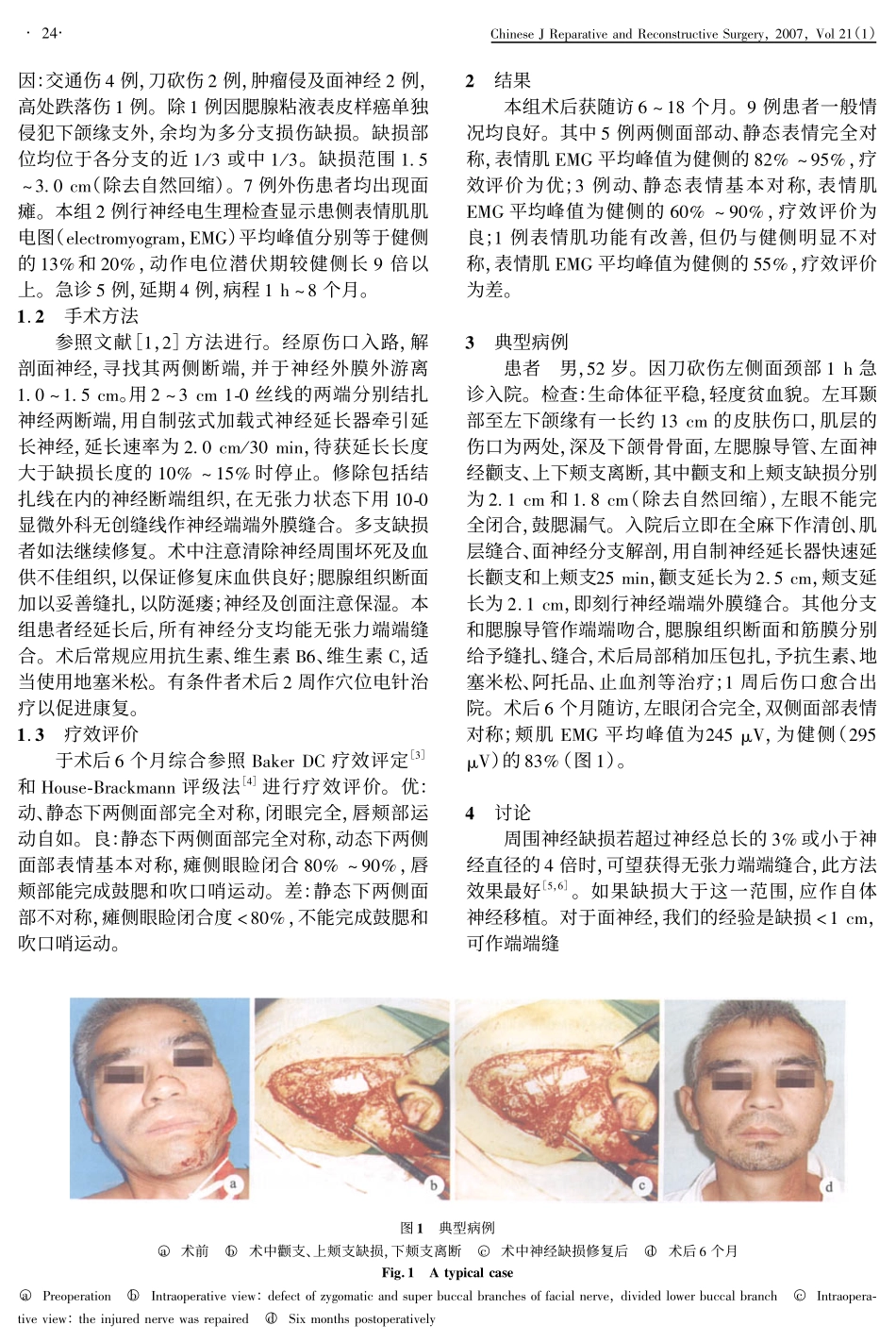 面神经缺损快速延长后即刻端端吻合修复的初步临床应用_第2页