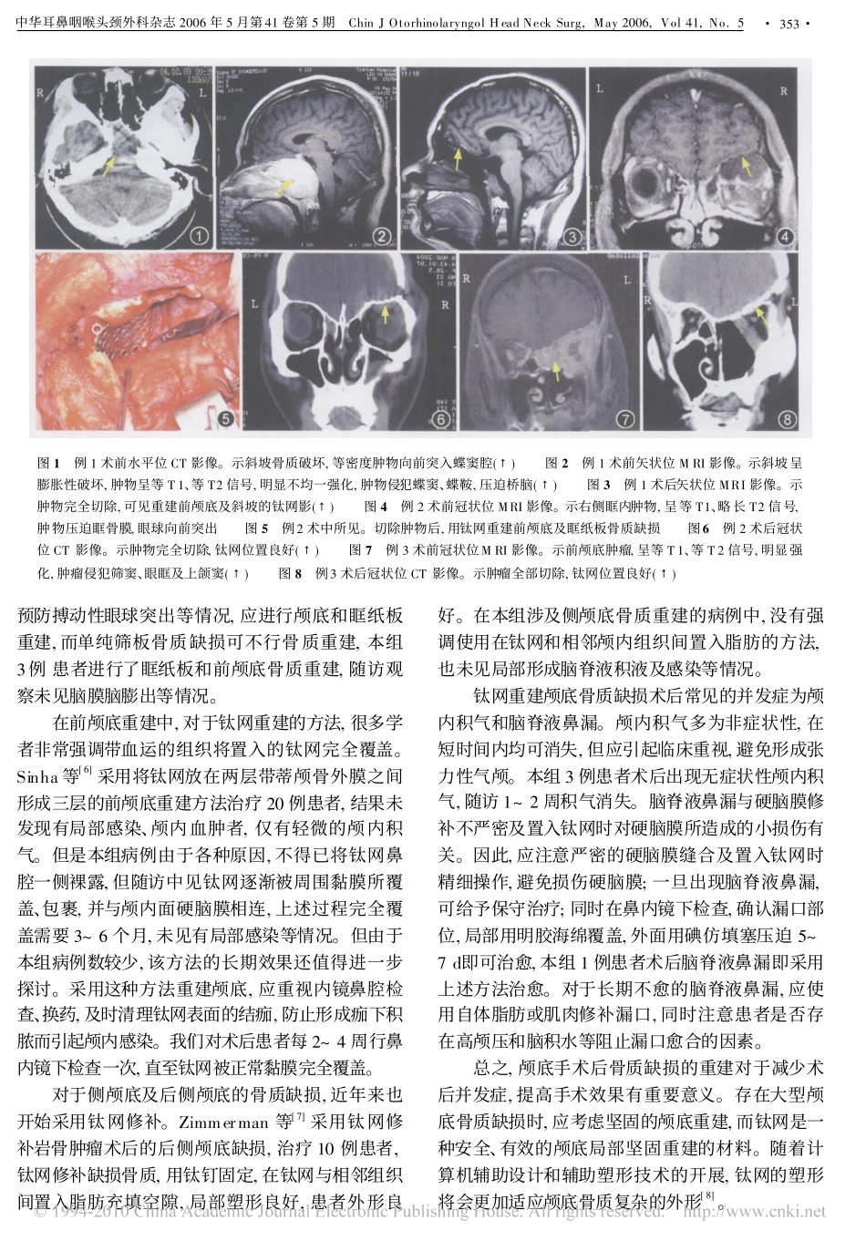 颅底术后骨质缺损的钛网重建_第3页