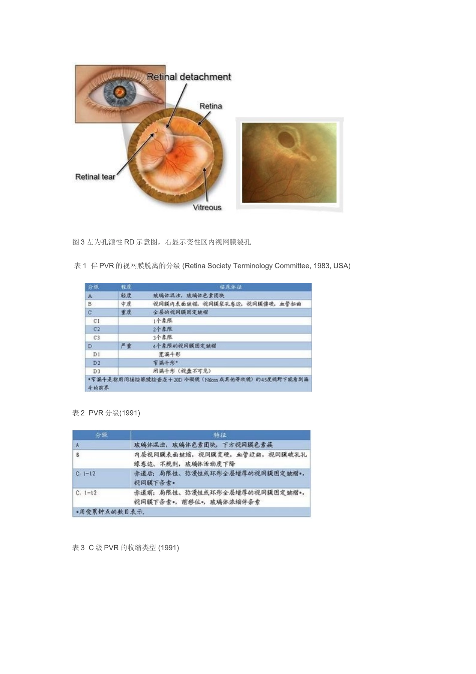 视网膜脱离诊断程序_第2页