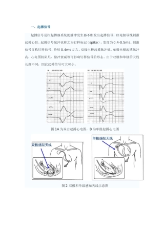 起搏心电图相关概念