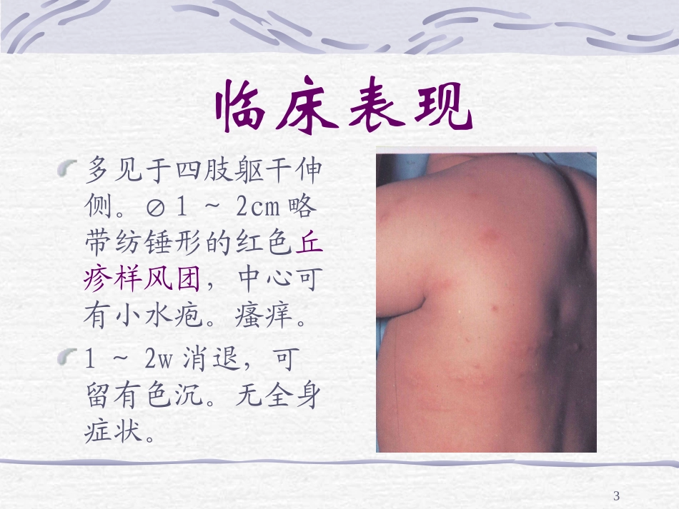 丘疹性荨麻疹_第3页