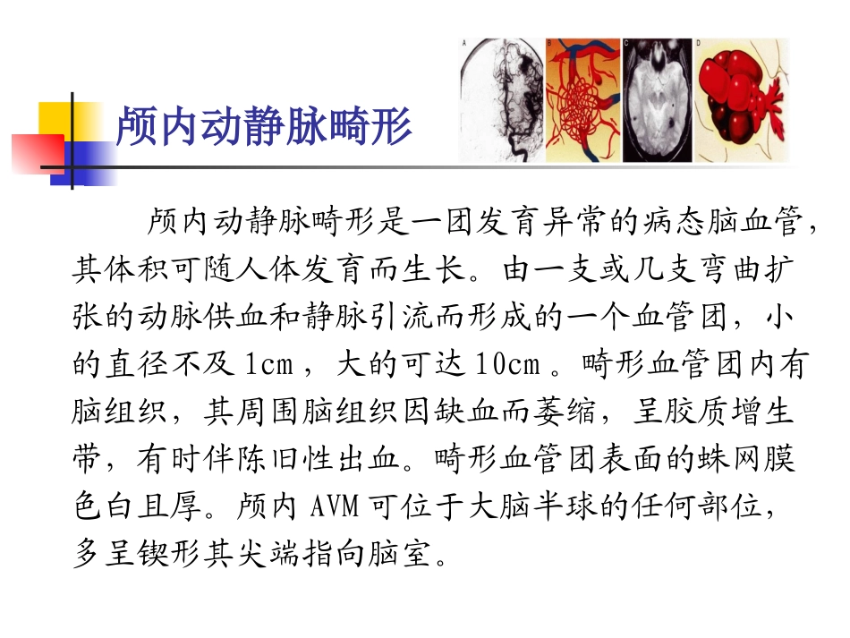脑血管畸形诊治_第2页