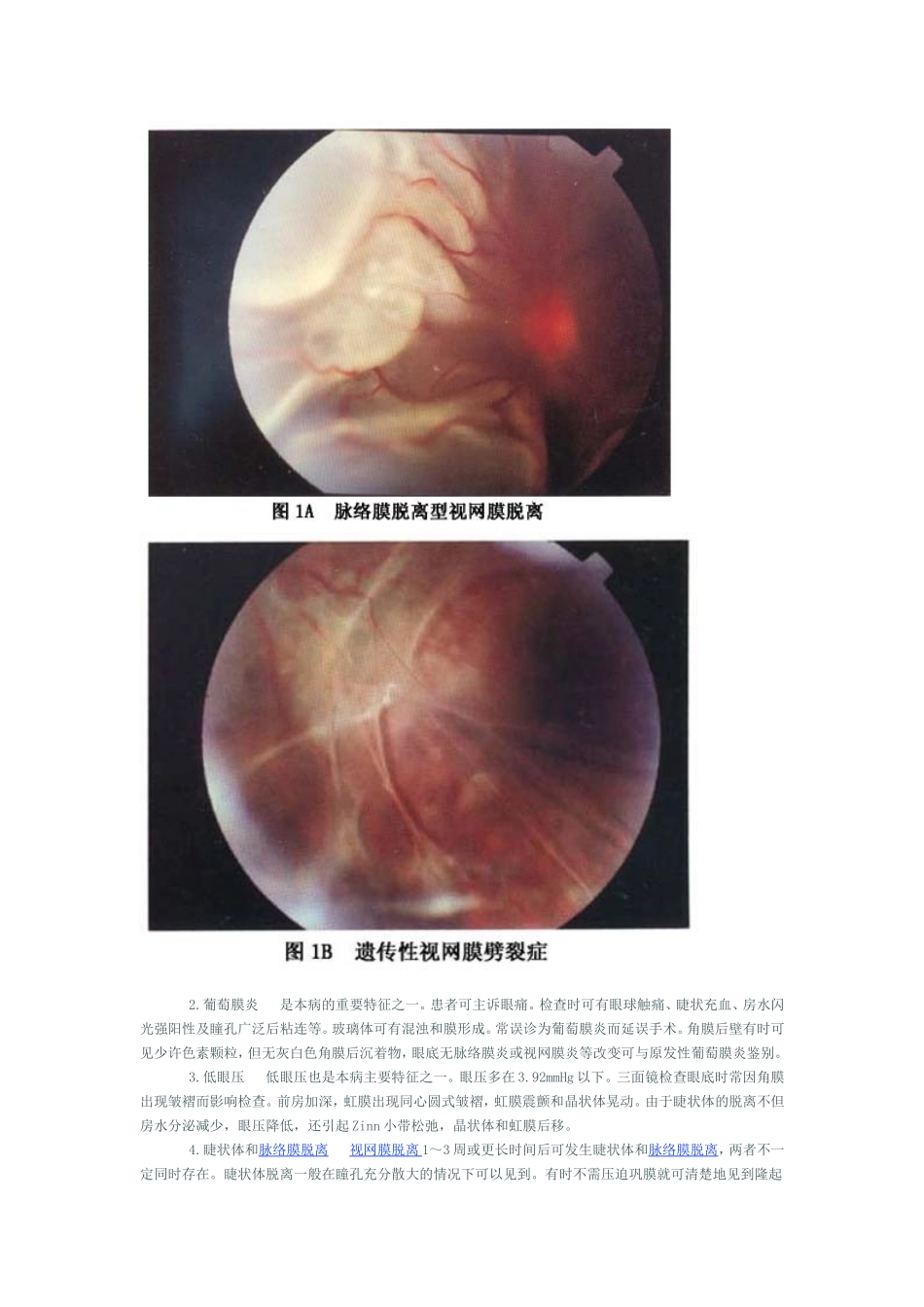 脉络膜脱离型视网膜脱离_第2页