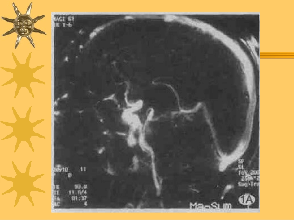 颅内静脉窦血栓形成_第3页