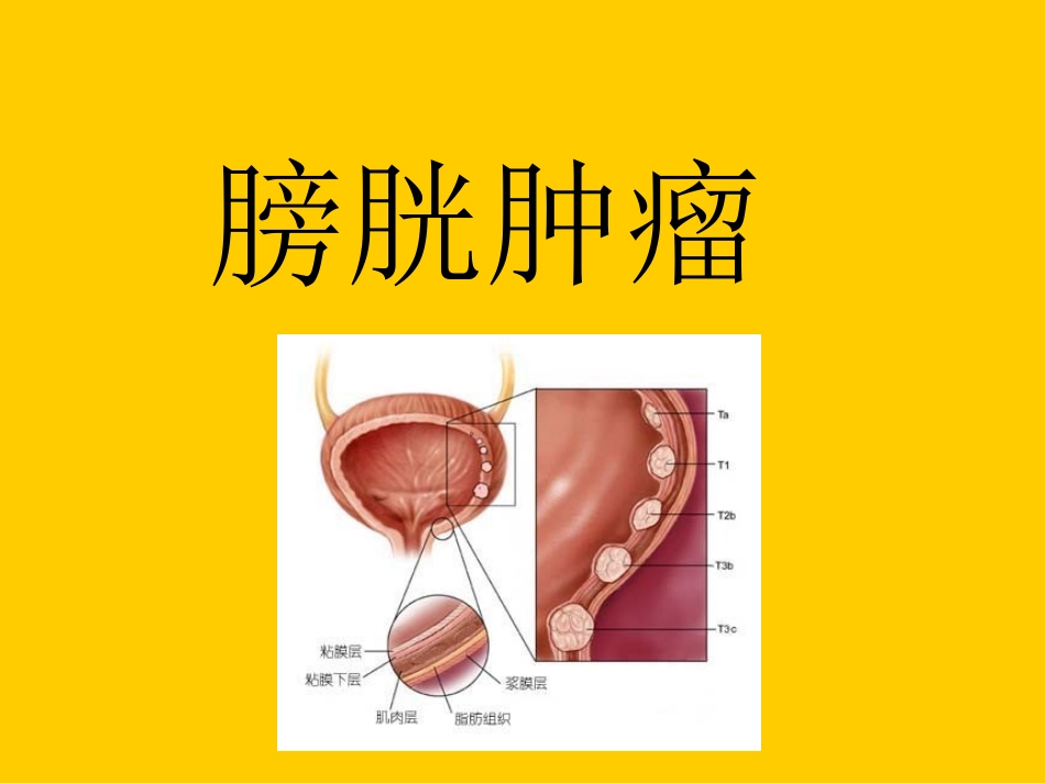 膀胱肿瘤2011-1-18_第1页