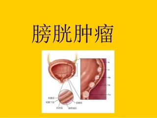 膀胱肿瘤2011-1-18