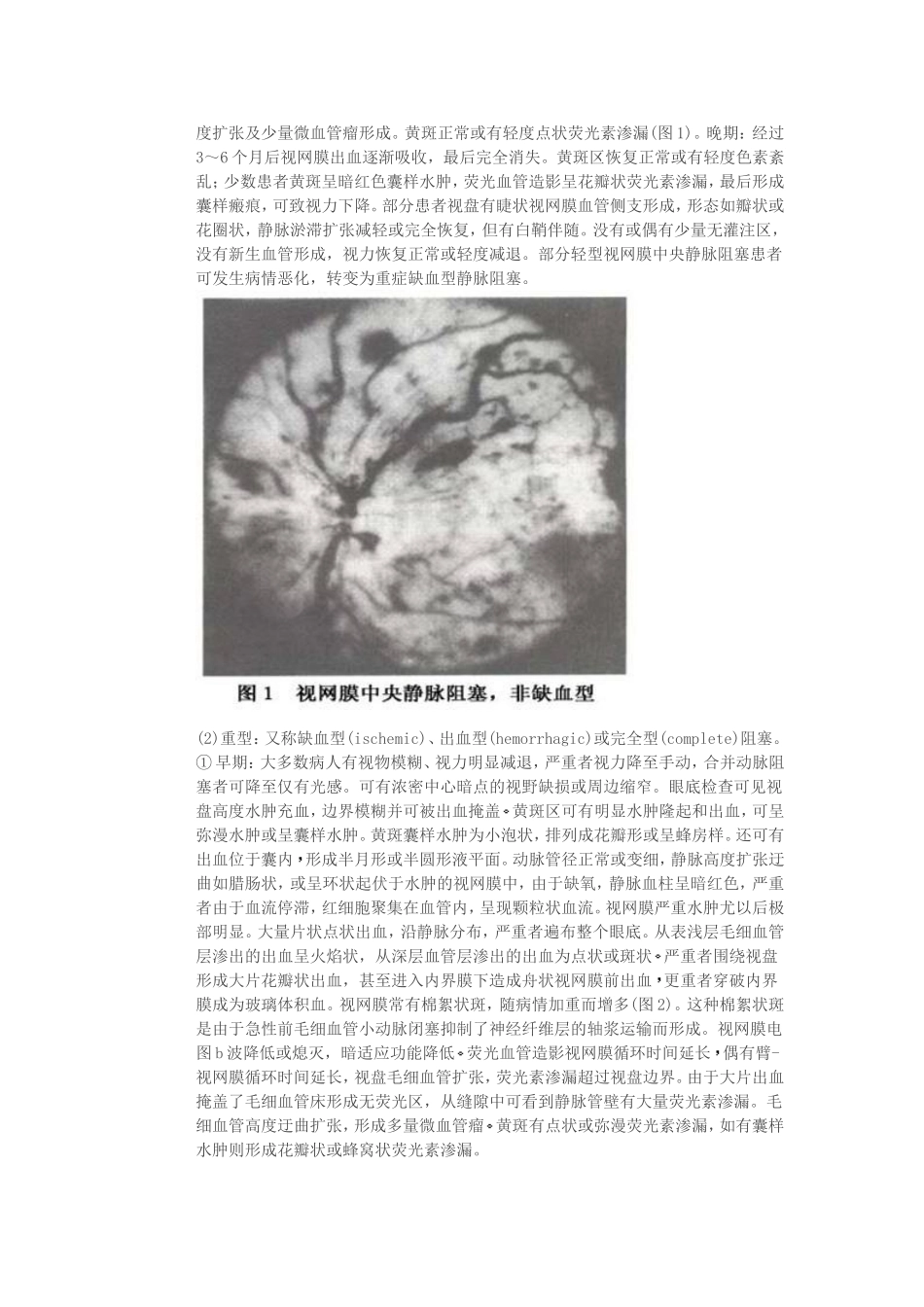视网膜静脉阻塞_第3页