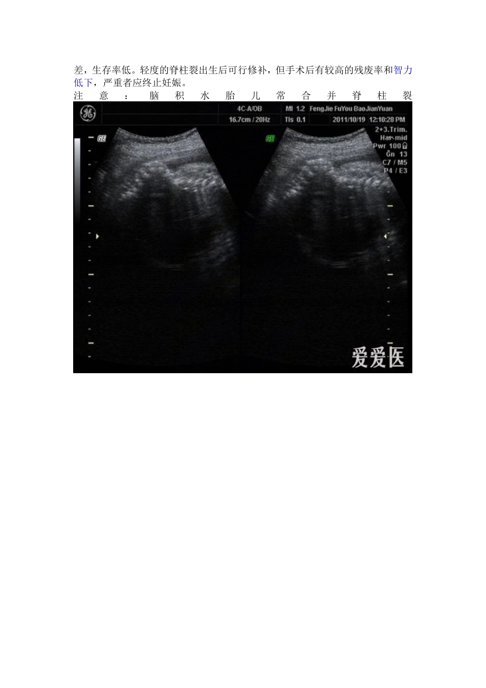 脑积水合并脊柱裂_第2页