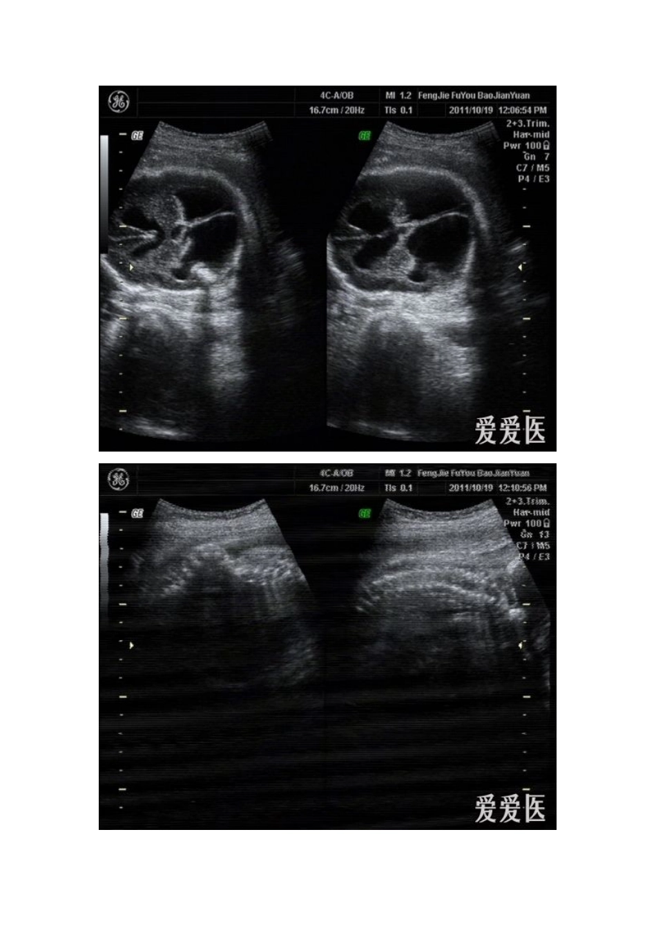 脑积水合并脊柱裂_第3页