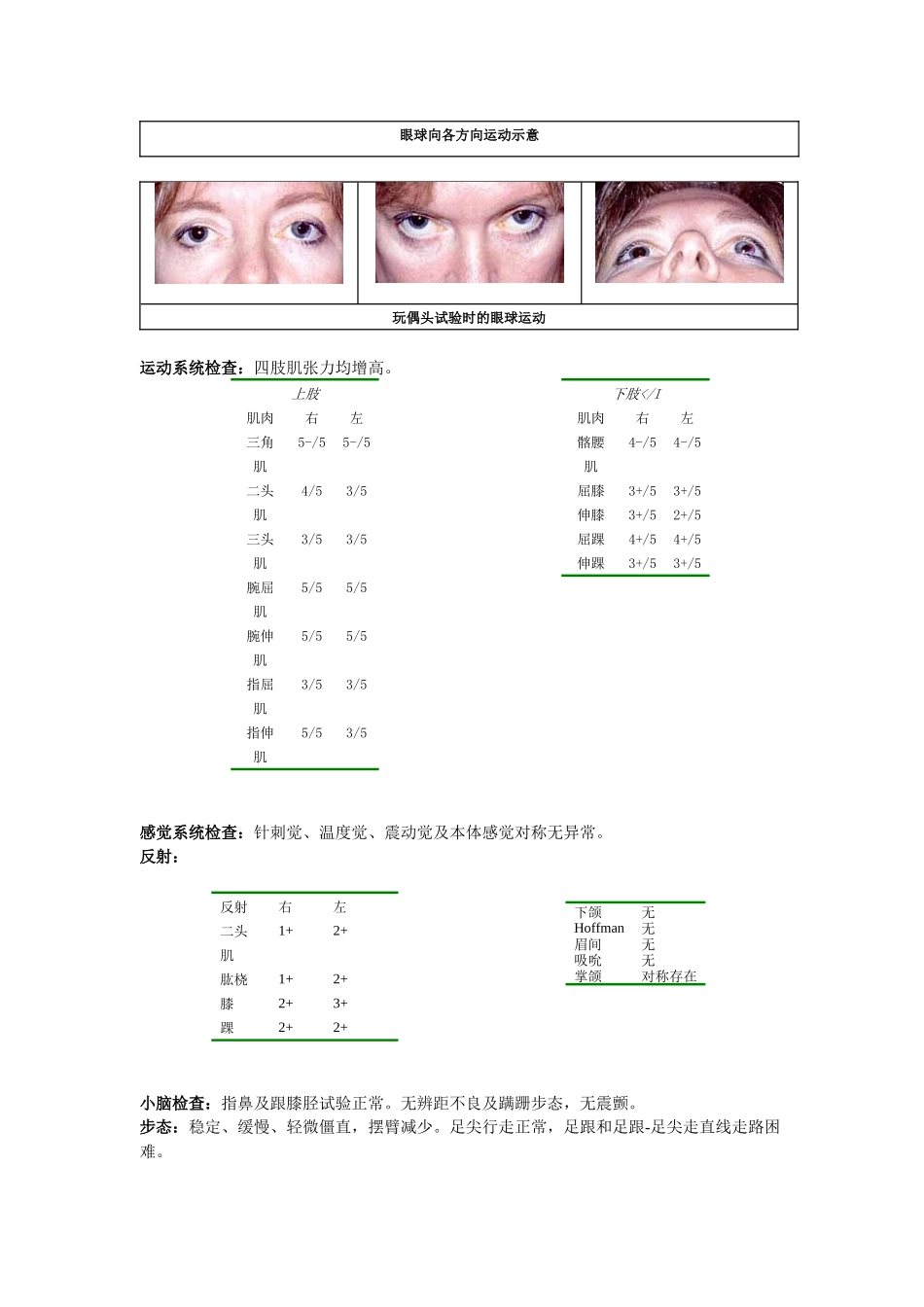 神经科疑难病例——进行性核上性眼肌麻痹_第2页