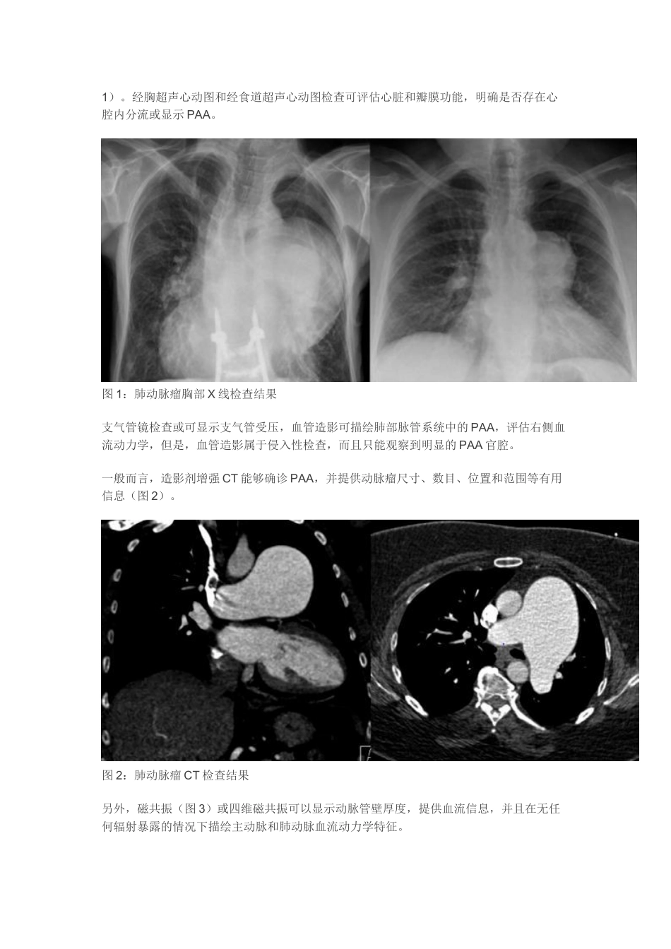 临床综述肺动脉瘤_第3页