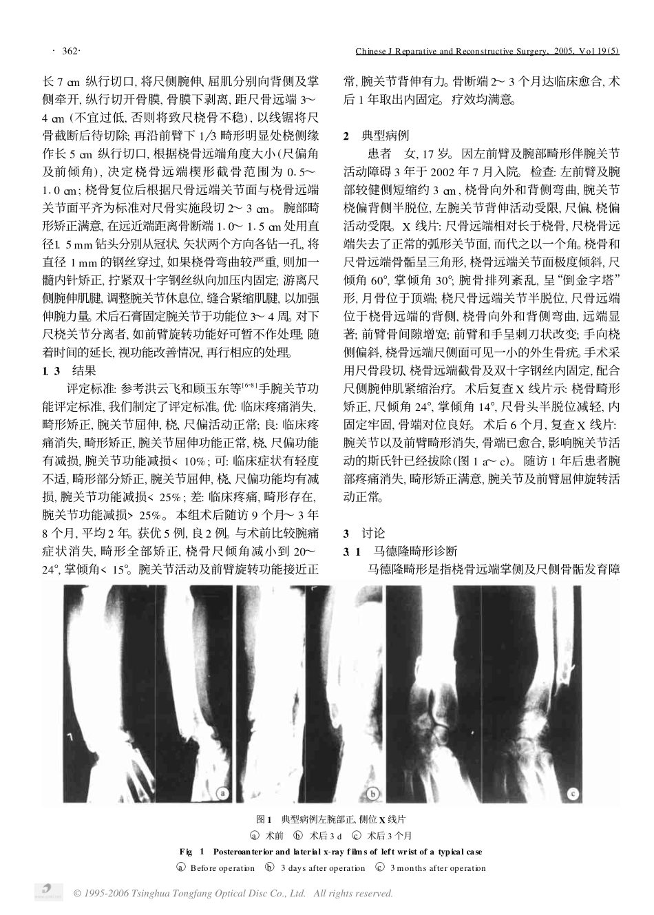 马德隆畸形的治疗方法探讨_第2页