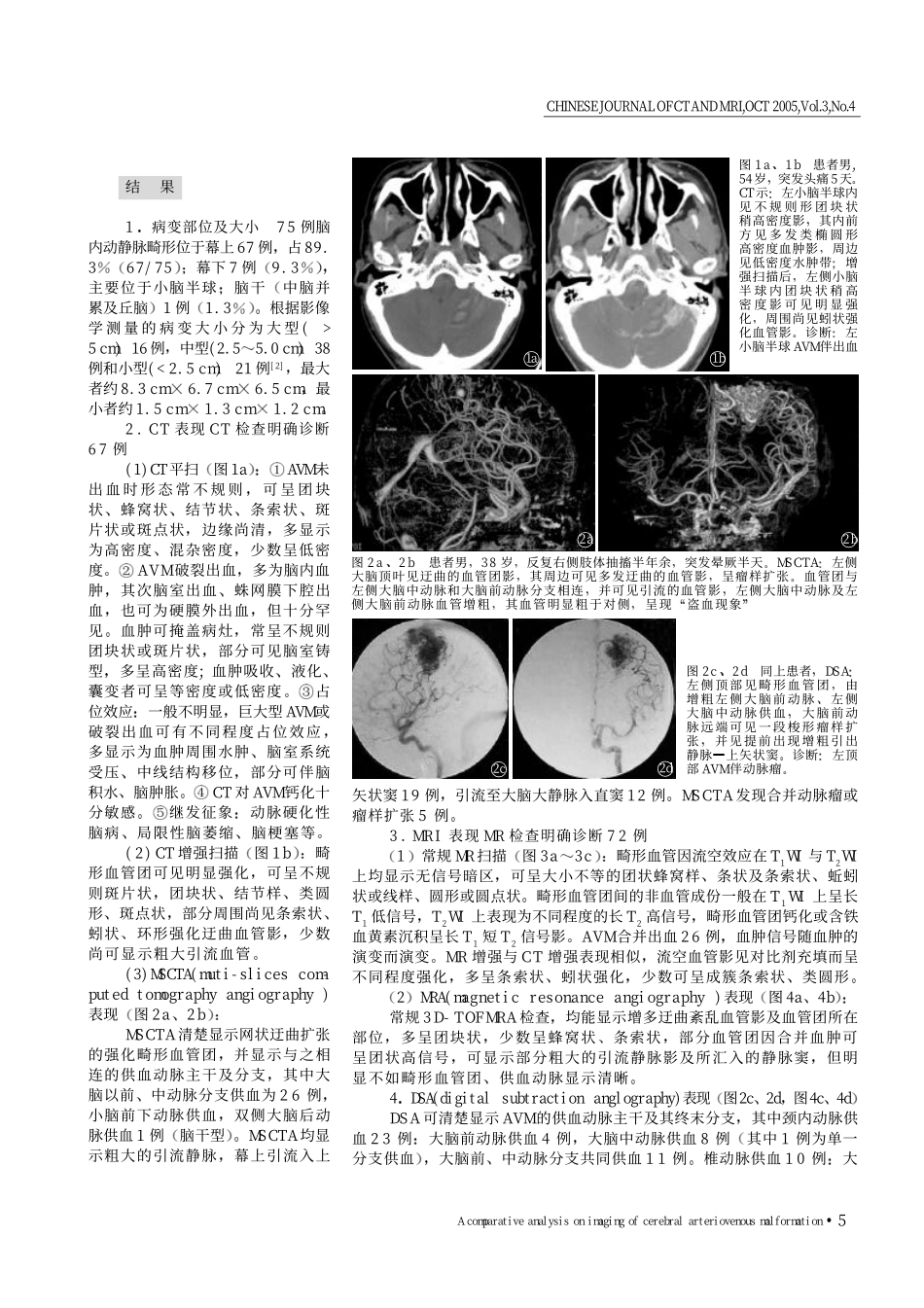 脑动静脉畸形的影像学表现比较分析_第2页