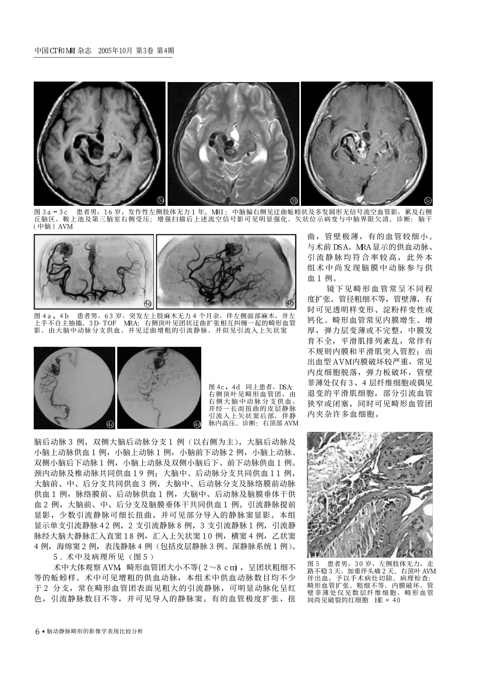 脑动静脉畸形的影像学表现比较分析_第3页