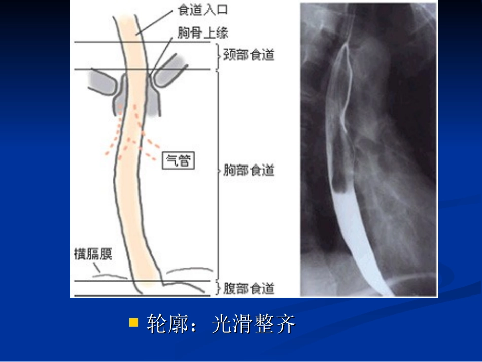 食管的正常X线表现_第3页