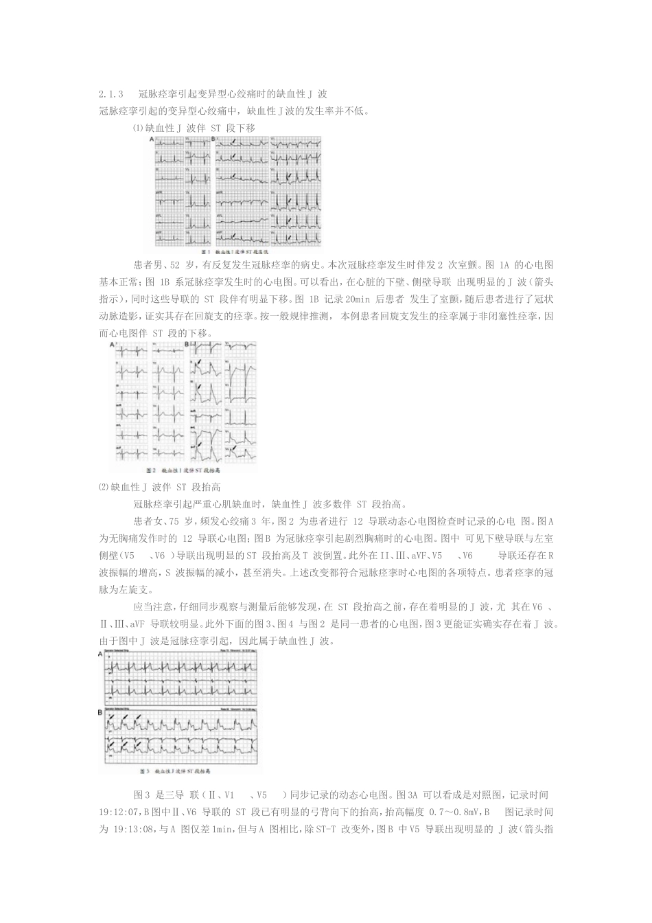 缺血性 J 波_第2页