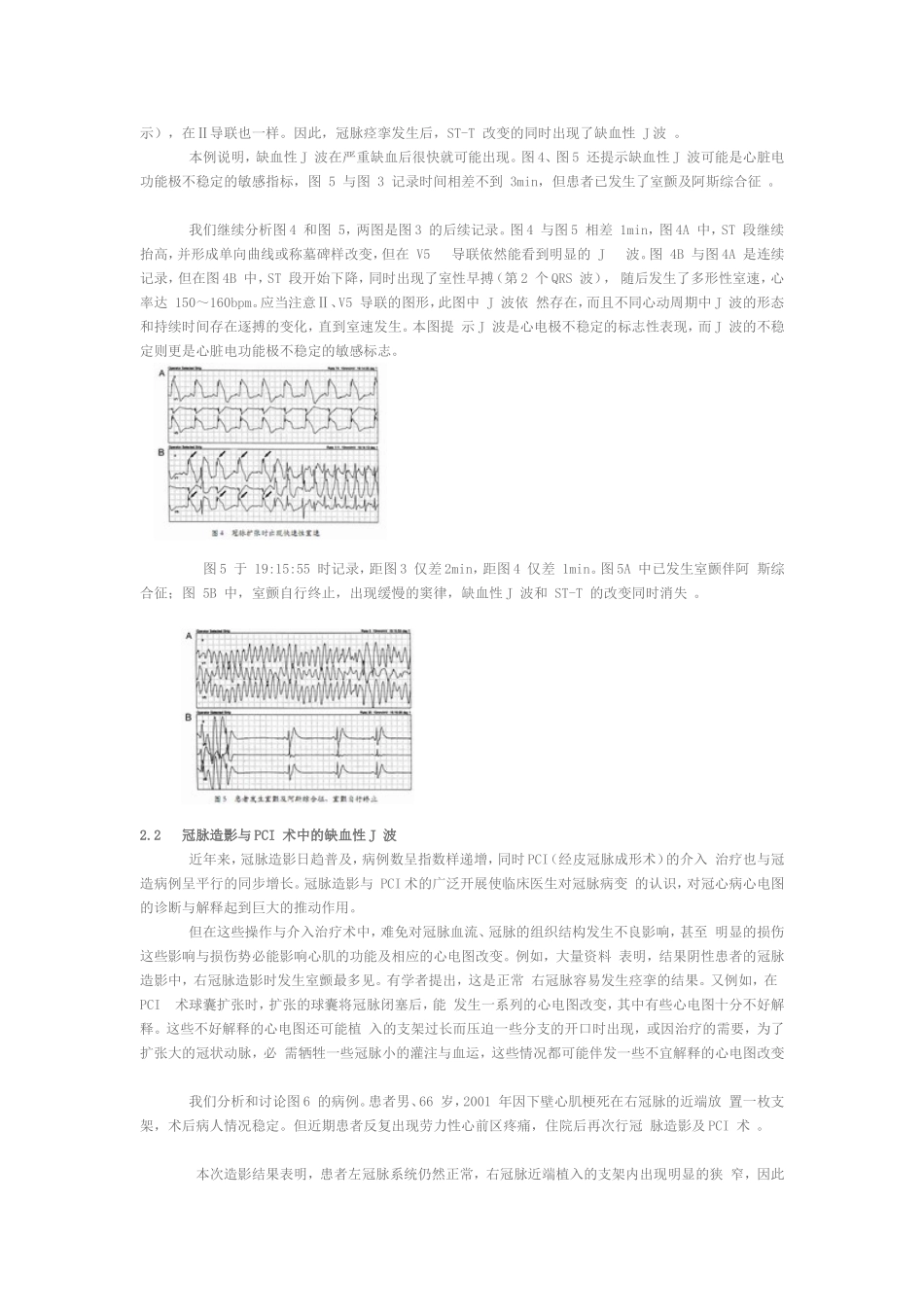 缺血性 J 波_第3页