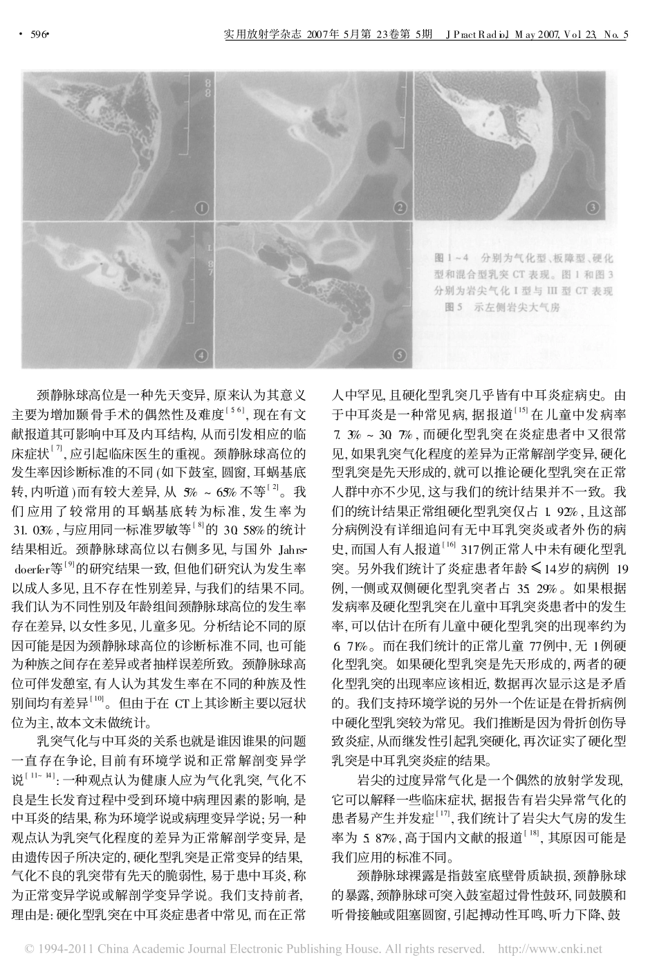 颞骨气化与颈静脉球高位关系的CT分析_第3页