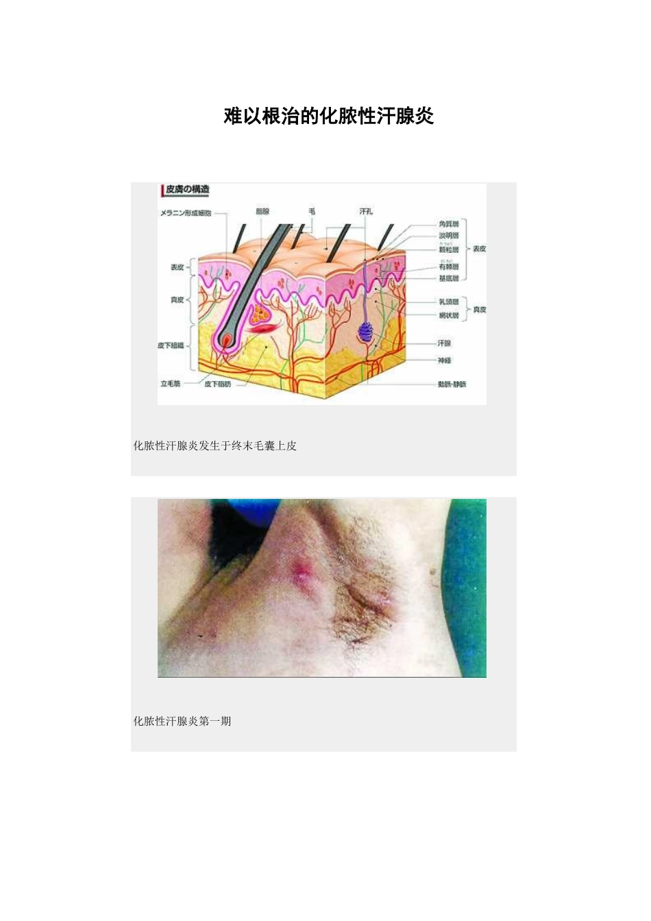 难以根治的化脓性汗腺炎_第1页