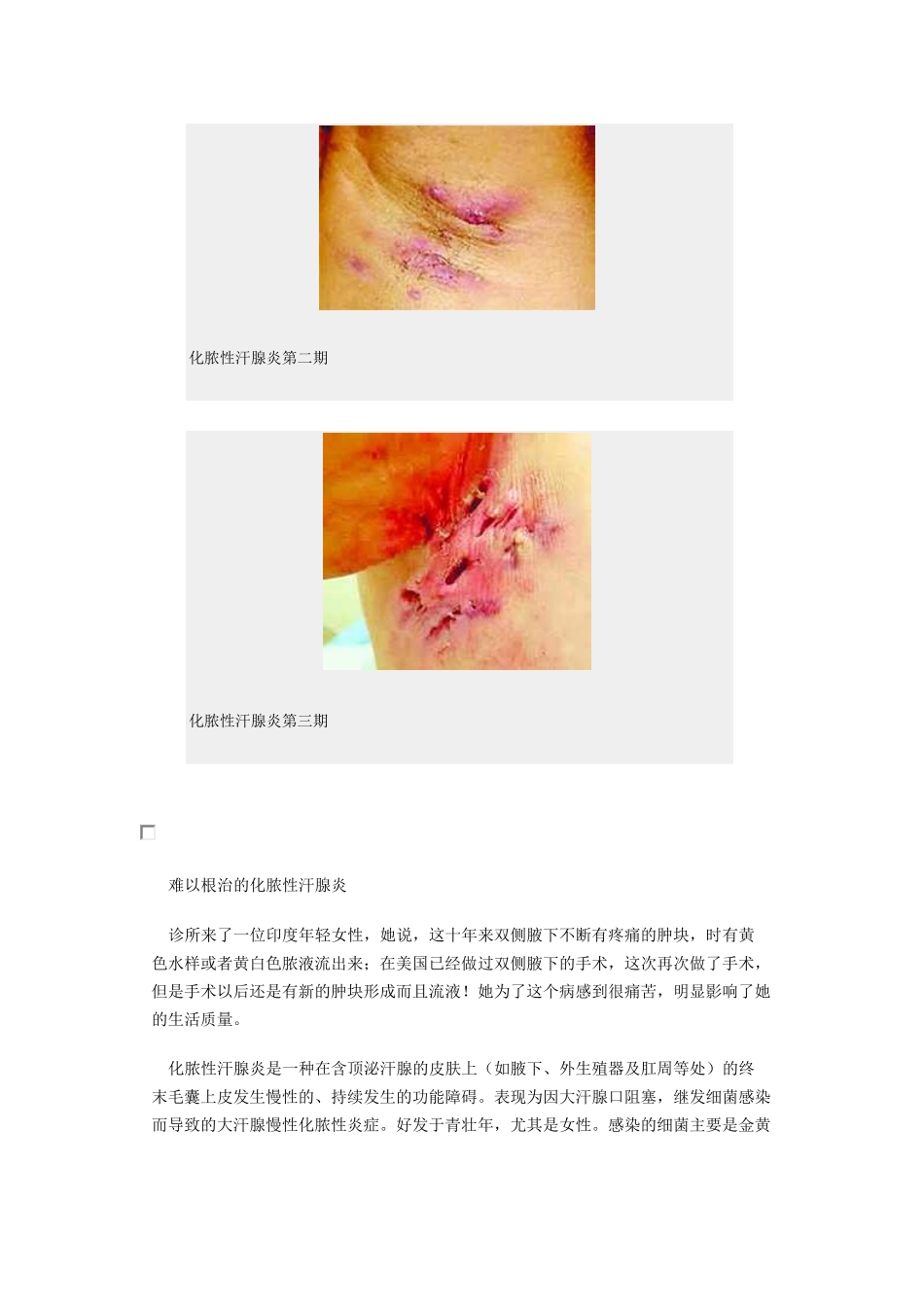 难以根治的化脓性汗腺炎_第2页