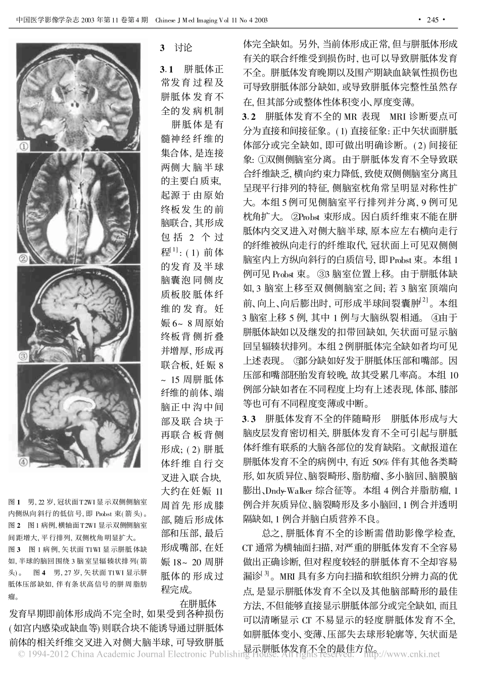 胼胝体发育不全的MRI诊断_第2页