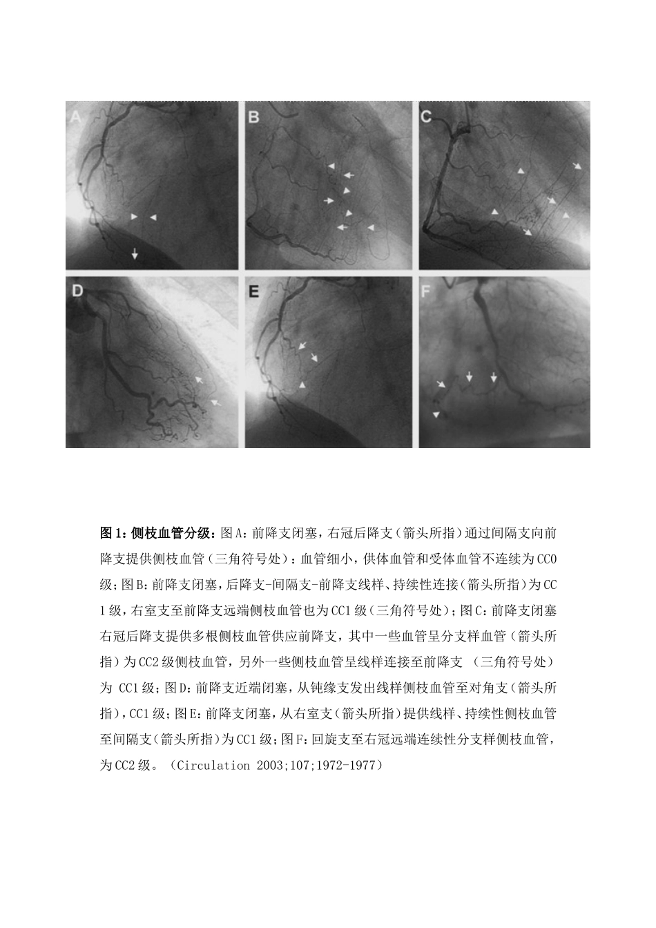 逆向导引钢丝技术侧枝血管的选择_第2页