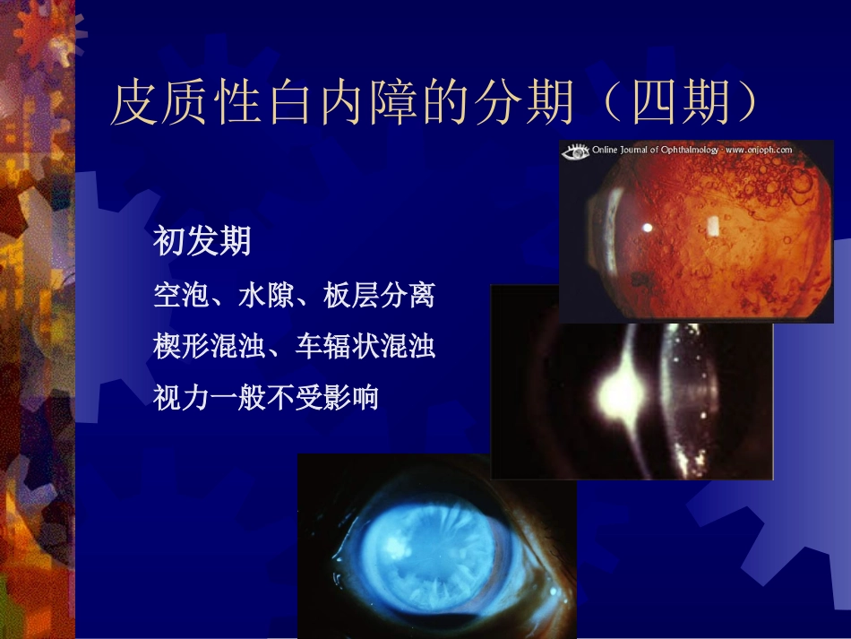 皮质性白内障的分期(四期)_第1页