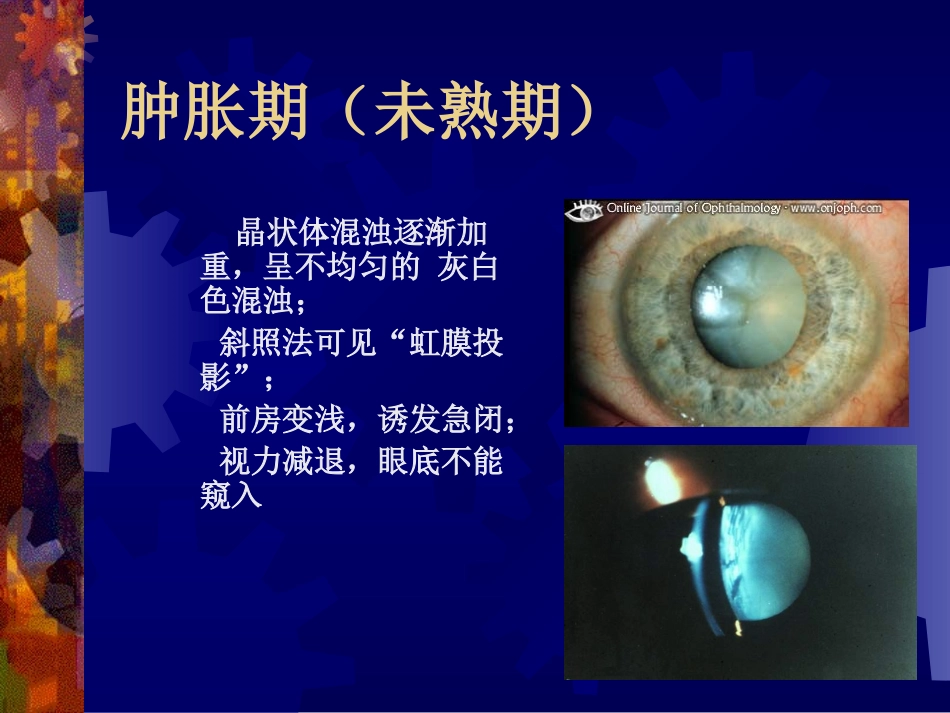 皮质性白内障的分期(四期)_第2页