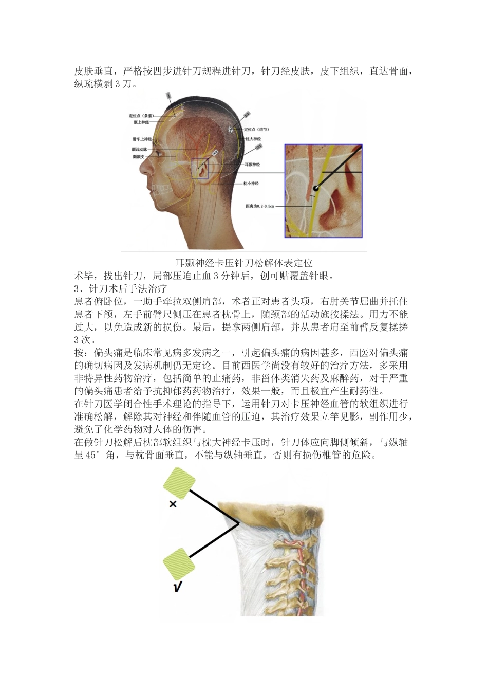 偏头痛的原因是什么,针刀怎样治疗？_第3页
