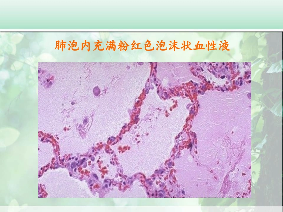 输液并发症- 急性肺水肿处置_第3页