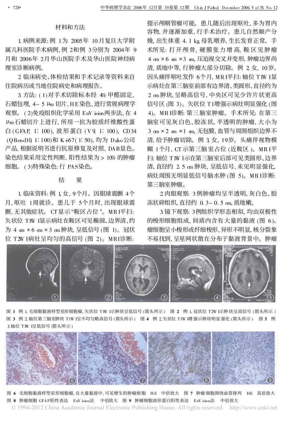 毛细胞黏液样型星形细胞瘤的临床病理学观察_陈莲_第2页