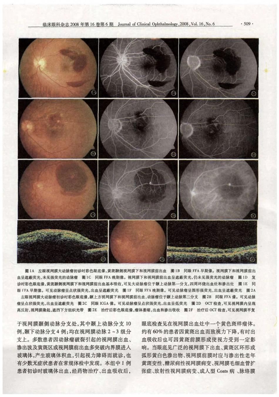 视网膜大动脉瘤临床分析_第3页