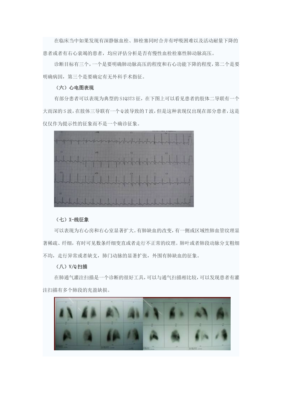 慢性血栓栓塞性肺动脉高压外科治疗_第3页