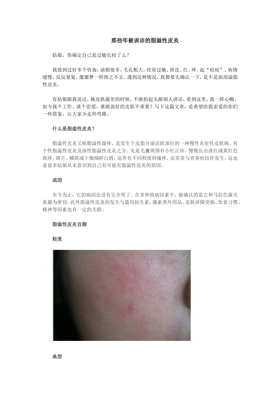 那些年被误诊的脂溢性皮炎。_第1页