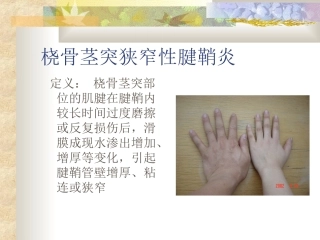 桡骨茎突狭窄性腱鞘炎