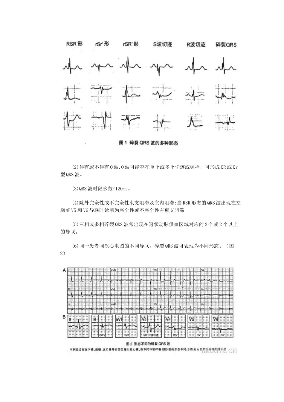 碎裂QRS波_第2页