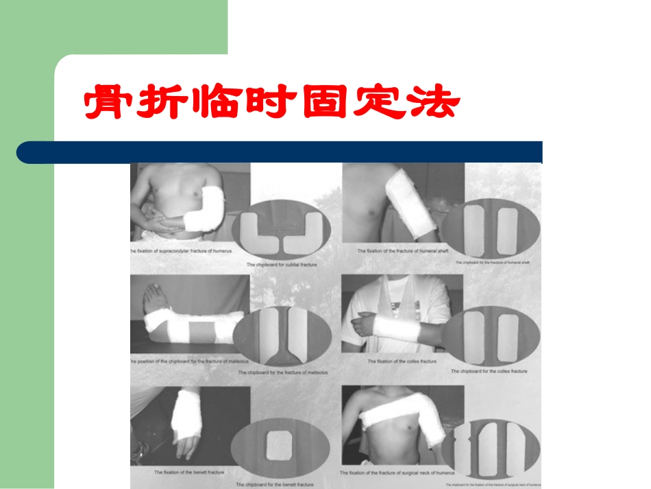 四肢骨折现场急救_第3页