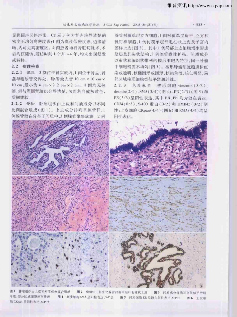 肾混合性上皮间质肿瘤4例报道及文献复习_第2页
