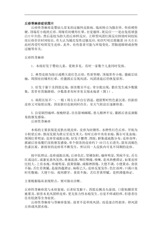 丘疹荨麻疹症状图片