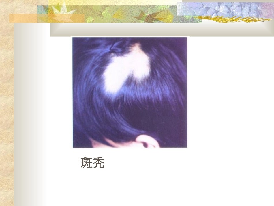 美容学-斑秃6_第3页
