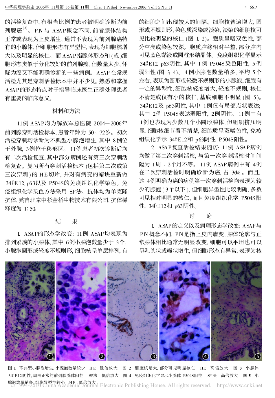 前列腺不典型小腺泡增生的病理形态及临床意义_第2页