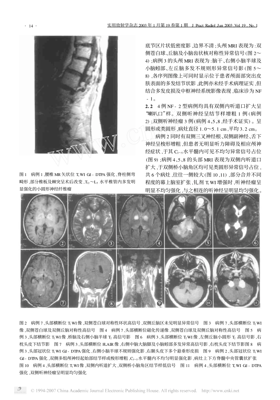神经纤维瘤病MR影像表现_第3页
