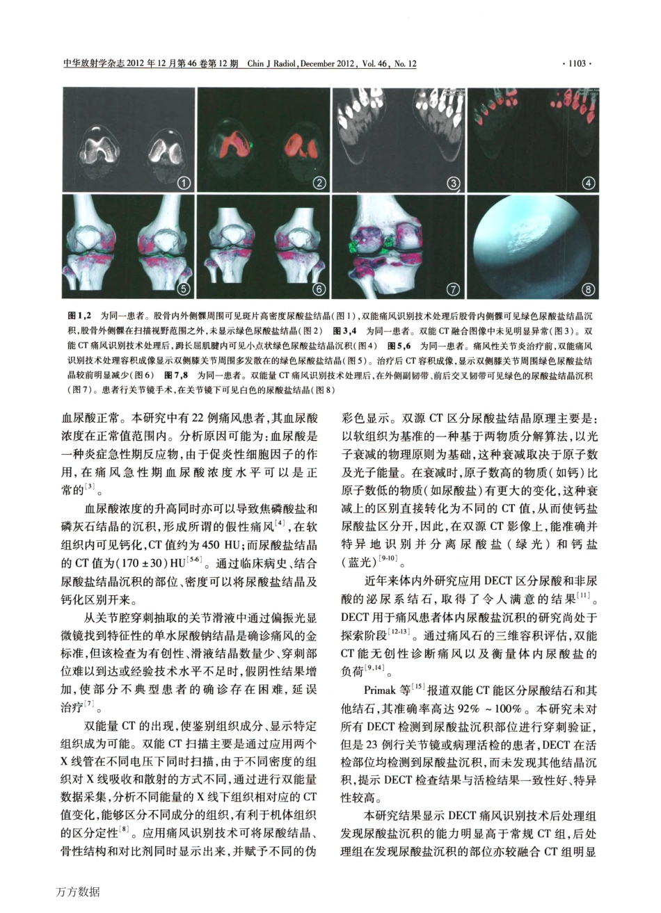 双源CT痛风识别技术在检测尿酸盐沉积中的应用_第3页