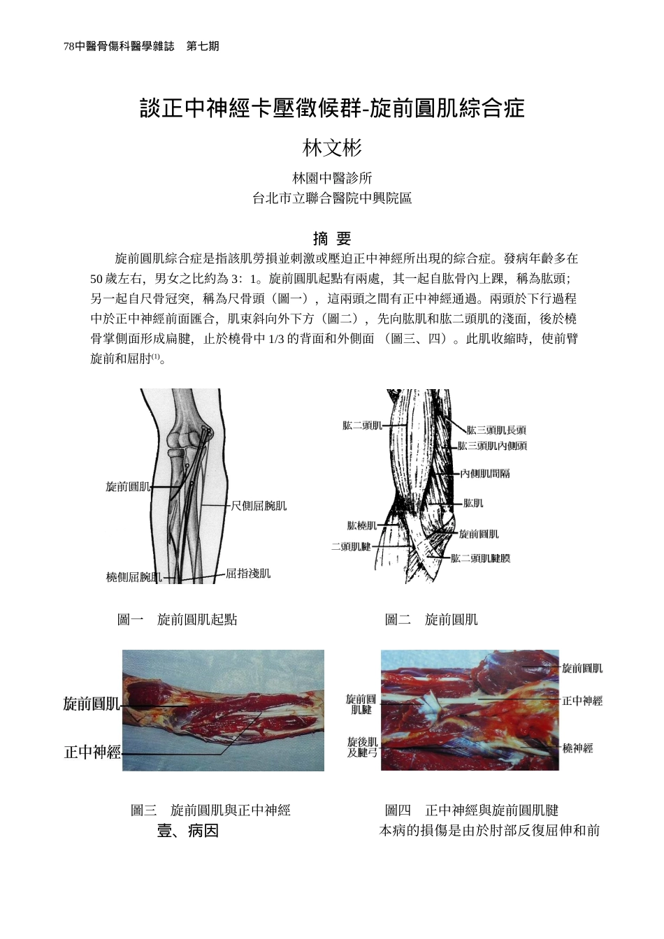 谈正中神经卡压徵候群-旋前圆肌综合症_第1页