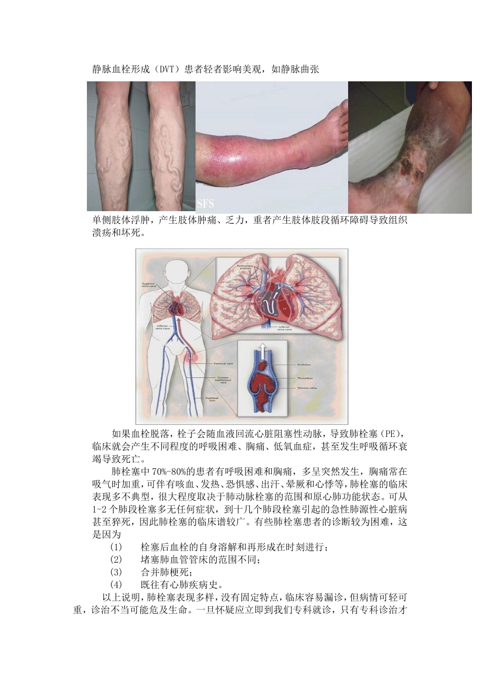 认识静脉血栓栓塞症_第3页