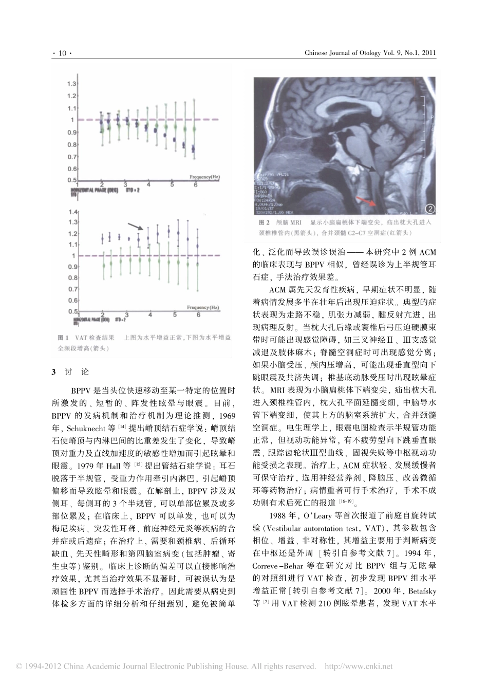 前庭自旋转试验在位置性眩晕患者中的检测_第3页